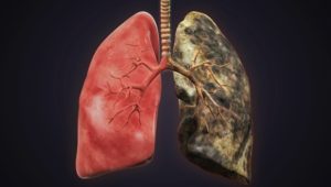 Lungs from cigarette addiction