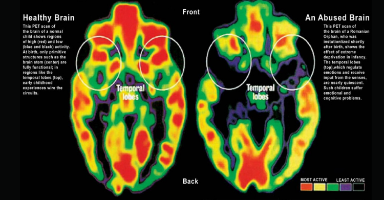childhood trauma brain