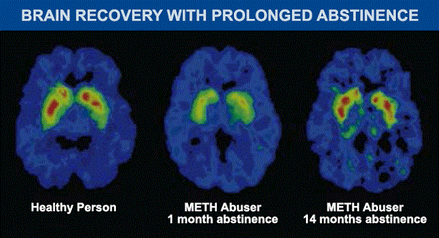 brain recovery of meth