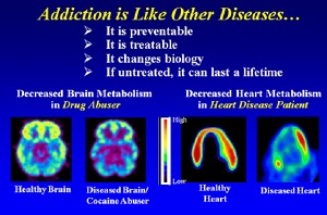 addiction is a disease