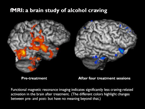 Alcohol craving in response to treatment