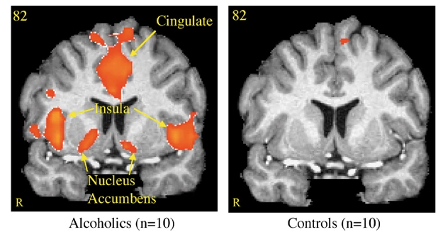 Brain activation for alcoholics vs social drinkers when presented with alcohol